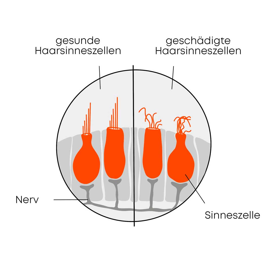 Gesunde und geschädigte Haarsinneszellen